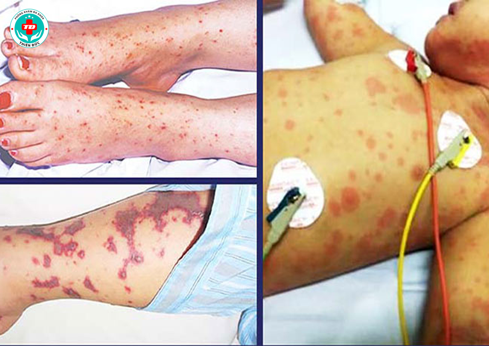 não mô cầu tăng số ca