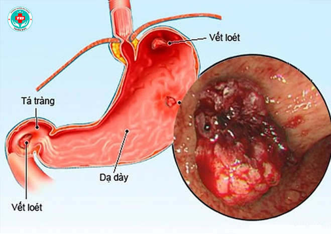 viêm loét dạ dày