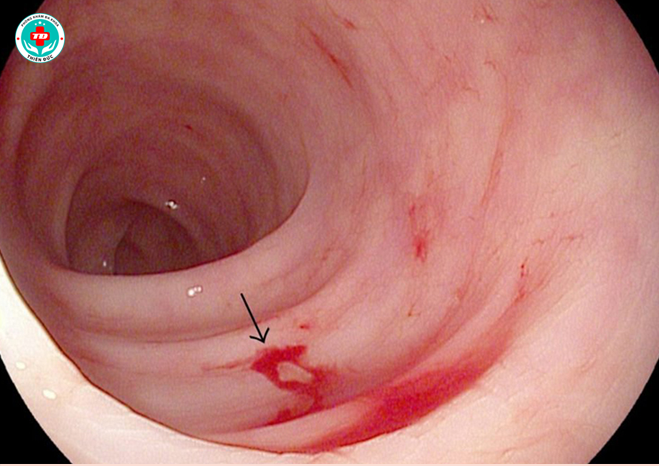 xuất huyết dạ dày