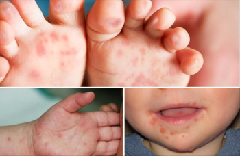 Bệnh tay chân miệng: Dấu hiệu nhận biết sớm và cách phòng ngừa