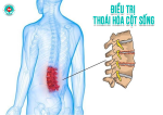 Điều trị thoái hóa cột sống