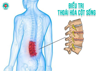 Điều trị thoái hóa cột sống