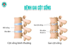 Bệnh gai cột sống: Triệu chứng, nguyên nhân và cách điều trị