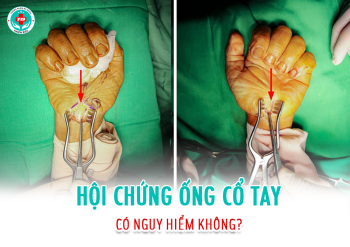Hội chứng ống cổ tay có nguy hiểm không?
