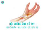 Hội chứng ống cổ tay là bệnh gì?