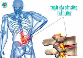 Thoái hóa cột sống: Dấu hiệu, nguyên nhân