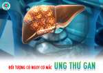 Đối tượng nguy cơ cao mắc ung thư gan
