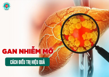 Các phương pháp điều trị gan nhiễm mỡ hiệu quả