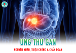 UNG THƯ GAN: Nguyên nhân - Triệu chứng & phương pháp chẩn đoán
