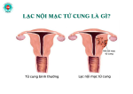 Lạc nội mạc tử cung - Căn bệnh 90% phụ nữ nhầm lẫn