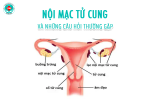Nội mạc tử cung: Vị trí, cấu tạo và chức năng