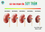 Các giai đoạn của bệnh suy thận