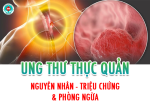 Ung thư thực quản: Nguyên nhân, triệu chứng và phòng ngừa