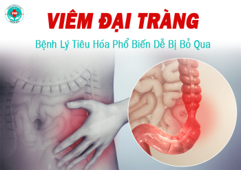 Viêm Đại Tràng – Bệnh Lý Tiêu Hóa Phổ Biến Dễ Bị Bỏ Qua