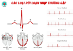 Các loại rối loạn nhịp tim thường gặp