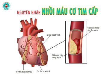 Nguyên nhân gây nên nhồi máu cơ tim cấp?